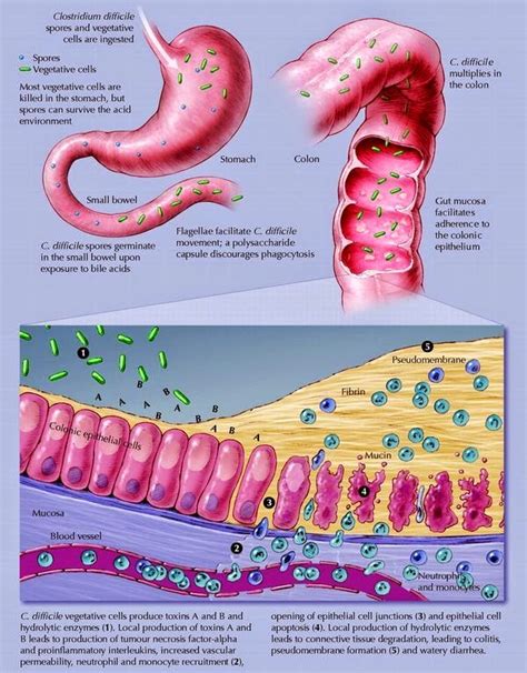 Clostridioides difficile (formerly clostridium difficile) colitis results from a disturbance of the normal bacterial flora of the colon, colonization by c difficile, and the release of toxins that cause mucosal. Clostridium difficile: Pathophysiology of C. diff colitis