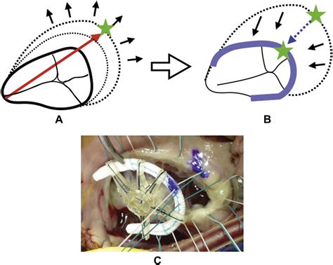 Shoulder Point Fitting Method As A New Universal Tricuspid Annuloplasty