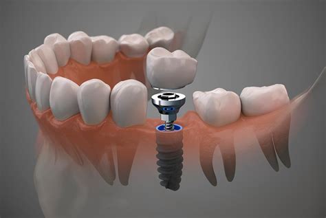 Implantes Dentales De Titanio