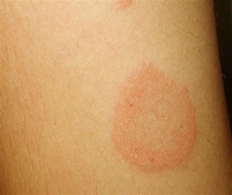 Pityriasis Rosea Stages New Health Advisor