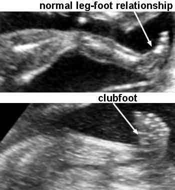 Description true clubfoot is characterized by abnormal bone formation in the foot. Skeleton - DIAGNOSIS OF FETAL ABNORMALITIES - THE 18-23 ...