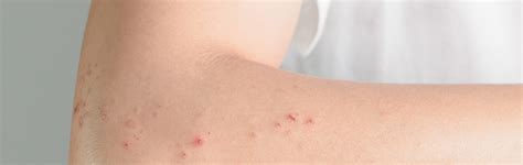 Shingles Treatment Dania Fl Now Accepting Appointments