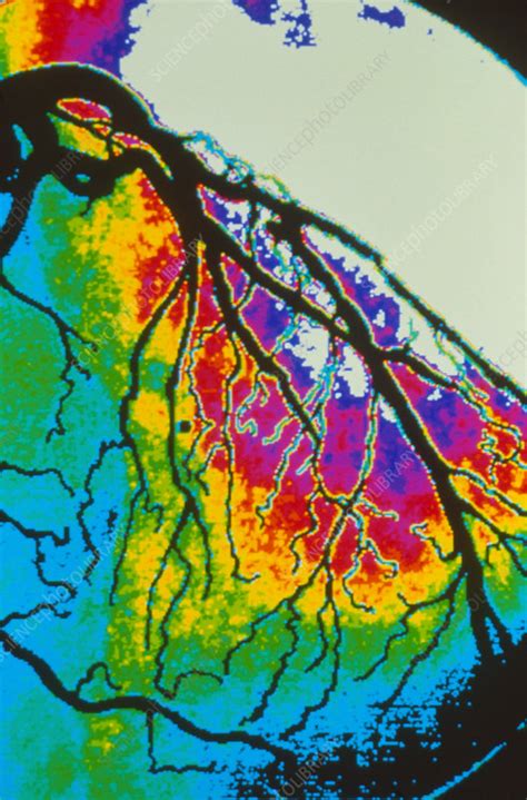 Coloured Angiogram Of Coronary Artery Of The Heart Stock Image P216