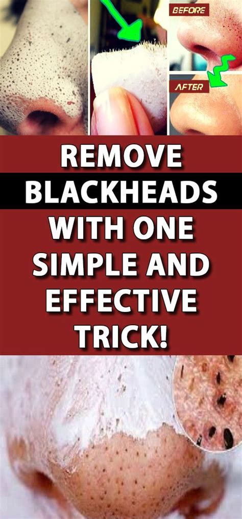 Use This Simple And Effective Trick And Get Rid Of Blackheads My Xxx Hot Girl