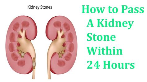 How To Pass A Kidney Stone Within 24 Hours Youtube
