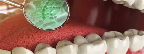 Potential Dangers Of Bacteria In The Mouth Implant And Perio Center Of