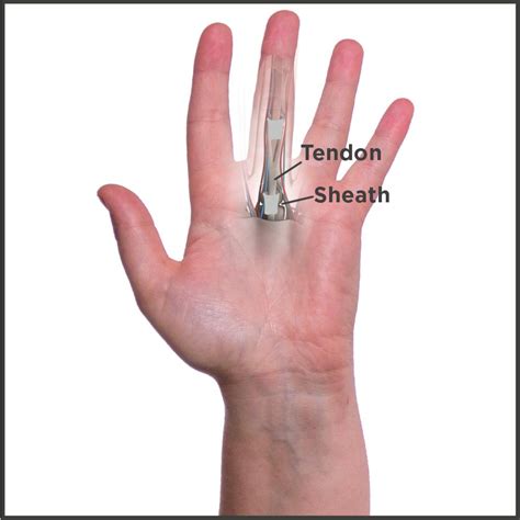Trigger Finger Treatment Solutions And Relief For Trigger Finger