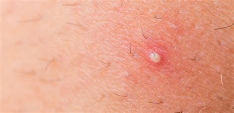 What To Do When You Have Ingrown Hair Tiphero