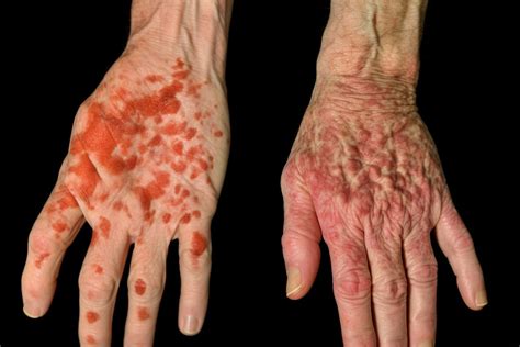 Psoriasis Vs Eczema The Key Differences You Need To Know By Leo Hayes