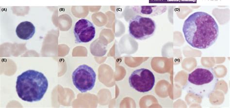 Atypical Lymphocytes Atypical Or Reactive Lymphocytes Are Lymphocytes