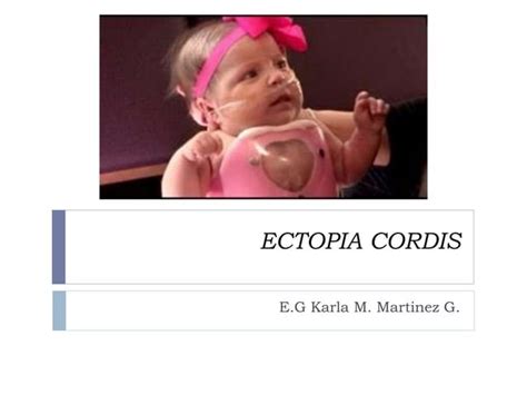 Ectopia Cordis Ppt