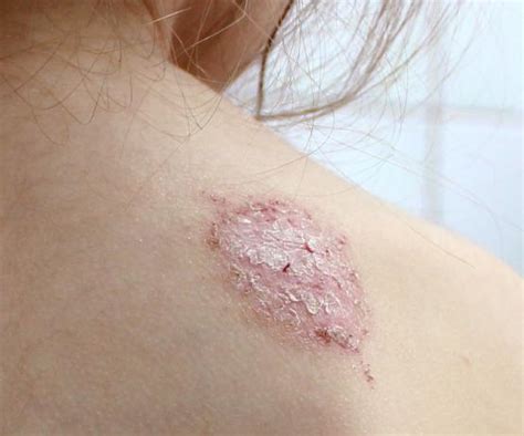 Eczema Treatment Reading Eczema Causes Symptoms And Treatments Derma