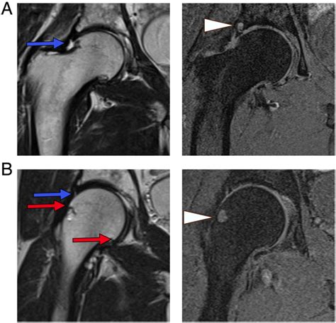 Mri Based Hip Cartilage Measures In Osteoarthritic And Non
