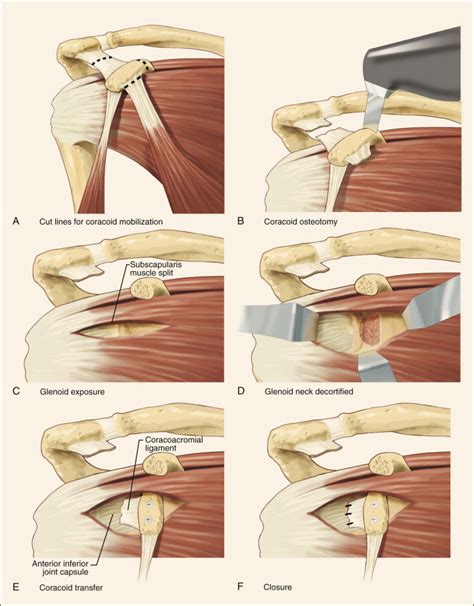 Anterior Shoulder Instability Musculoskeletal Key