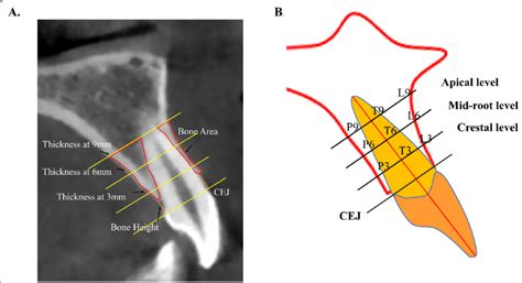 Determination Of Alveolar Bone Morphology In Incisors Alveolar Bone