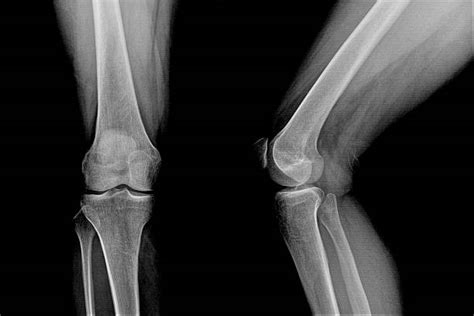 Leg Xray Stock Photos Pictures And Royalty Free Images Istock
