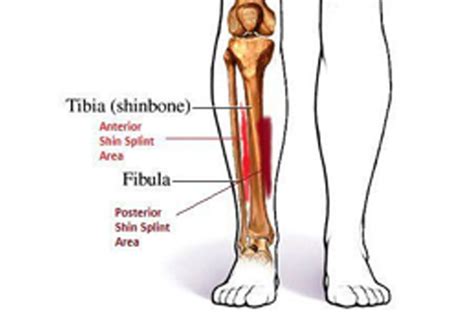 Shin Splints