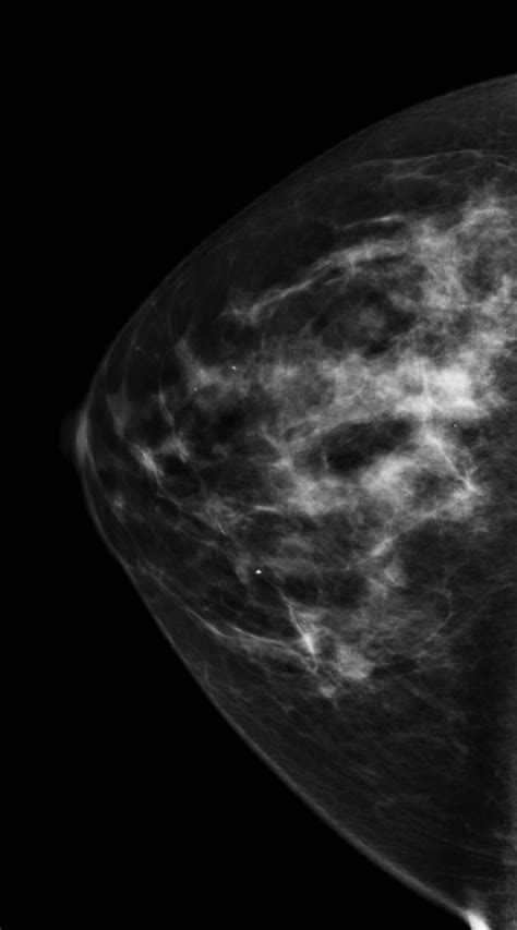 Extensive Ductal Carcinoma In Situ Image