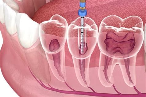 RCT Single Sitting Dentsee Dental Clinic