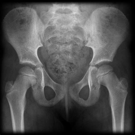Normal Pediatric Hipap X Ray Core Em