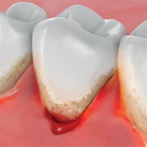 Why Do Gums Bleed Gum Recession Oral Hygiene Essex