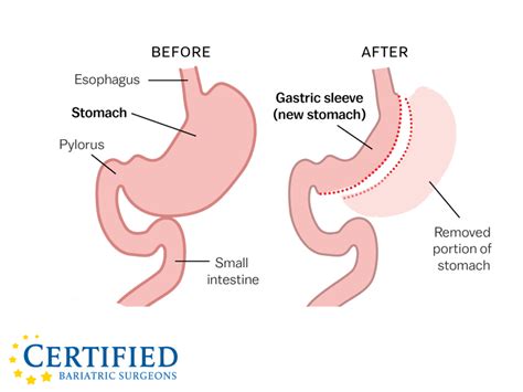 Gastric Sleeve Surgery Certified Bariatric Surgeons