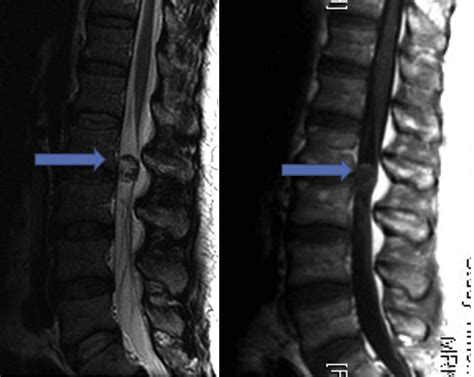 Spinal Schwannoma Presenting Due To Torsion And Hemorrhage Case Report