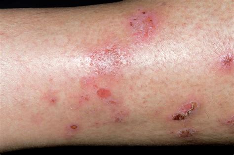 Spongiotic Dermatitis On The Leg Photograph By Dr P Marazzi Science Photo Library