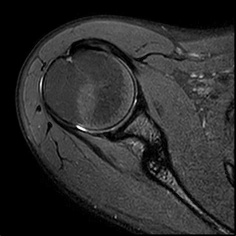 Normal Shoulder MRI Image Radiopaedia Org