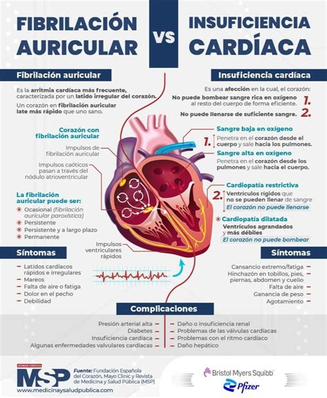 Fibrilacion Auricular Vs Insuficiencia Cardiaca Infografia By Msp