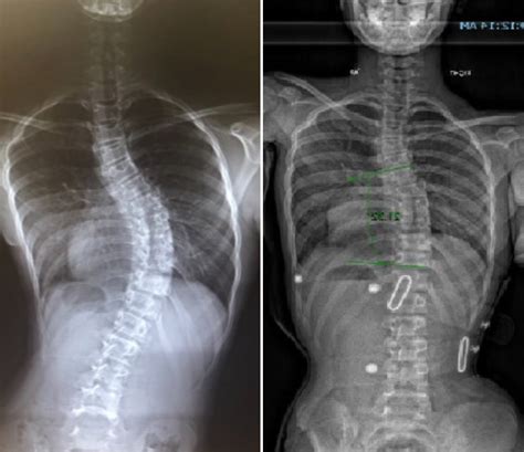 Loc Scoliosis Treatment Brace