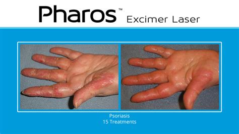 Ra Medical Systems Pharos Excimer Laserpsoriasis Before And After