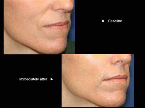 Juvederm Lips Before And After 12 Syringe Lips The Results Can