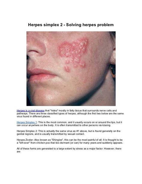 Herpes Simplex 2 Solving Genital Herpes Problem