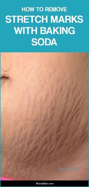 How To Use Baking Soda For Stretch Marks Artofit