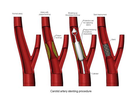 3d Printable Carotid Artery Stenting Procedure Diorama 3D Model 3D