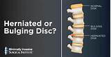 Best Treatment For Bulging Lumbar Disc Images
