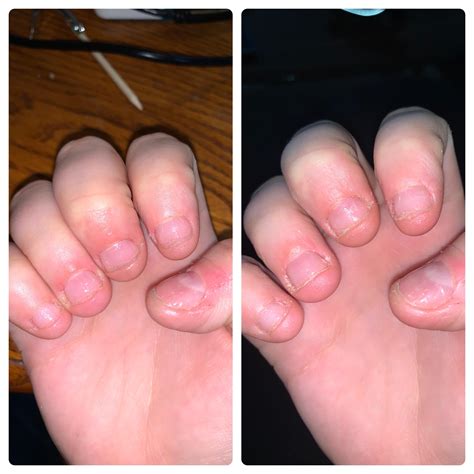 Need Help 5th Day No Biting Left Is After Cuticle Oil And Right Is