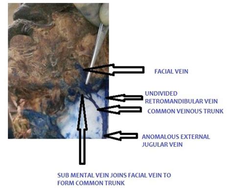 Figure 1 From Anatomical Variations In The Superficial Veins Of Head