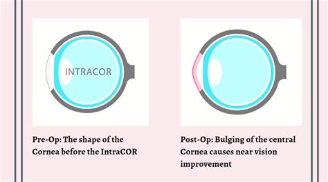 Intracor A Modern Ameliorate Technology For Presbyopic Correction
