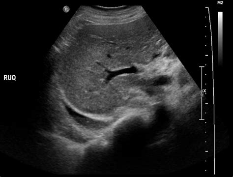 The procedure failures or ultrasound guidance is strongly recommended when attempting to aspirate any pleural effusion. Pleural effusion | Image | Radiopaedia.org