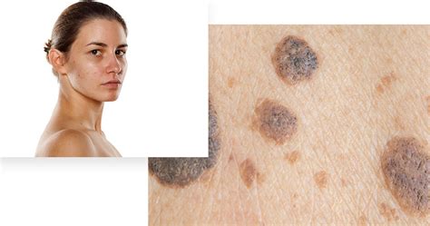 Brown Spots On The Skin Advanced Dermatology
