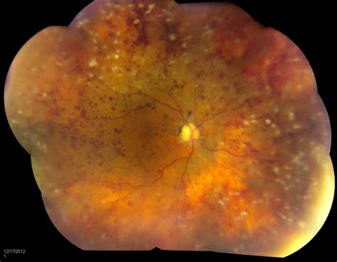 Central Retinal Vein Occlusion With Macular Edema And Retinal
