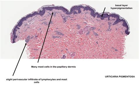 Dermatopathology Made Simple Inflammatory Infiltrates Of Cells Or