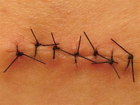 Neat Stitches For Medical Procedures