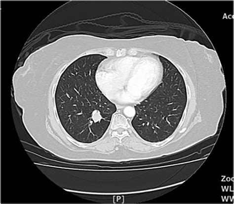 CT Thorax In Axial View Lung Window Showed A Solitary Lung Nodule In Download Scientific