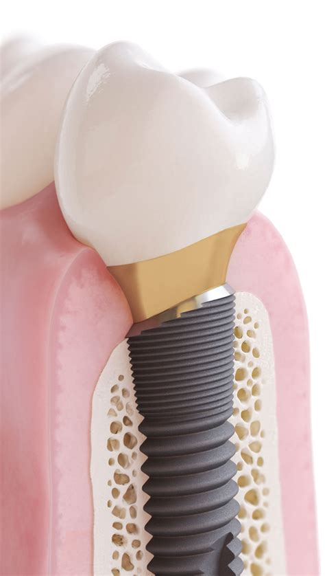 Dentsply Sirona Implants Implant Expo®