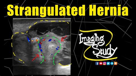 Strangulated Umbilical Hernia With Abscess Formation Ultrasound