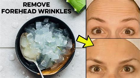 How To Get Rid Of Forehead Wrinkles Naturally 5 Home Remedies To Remove Forehead Wrinkles