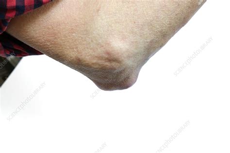 Rheumatoid Nodule Of The Elbow Stock Image C0238984 Science